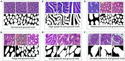 EBHI-Seg: A novel enteroscope biopsy histopathological hematoxylin and eosin image dataset for image segmentation tasks